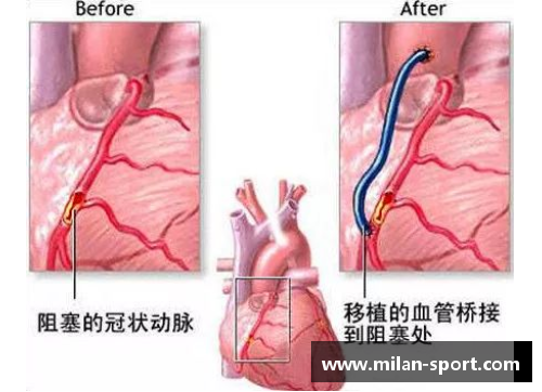 球员筋膜炎：症状、治疗与预防